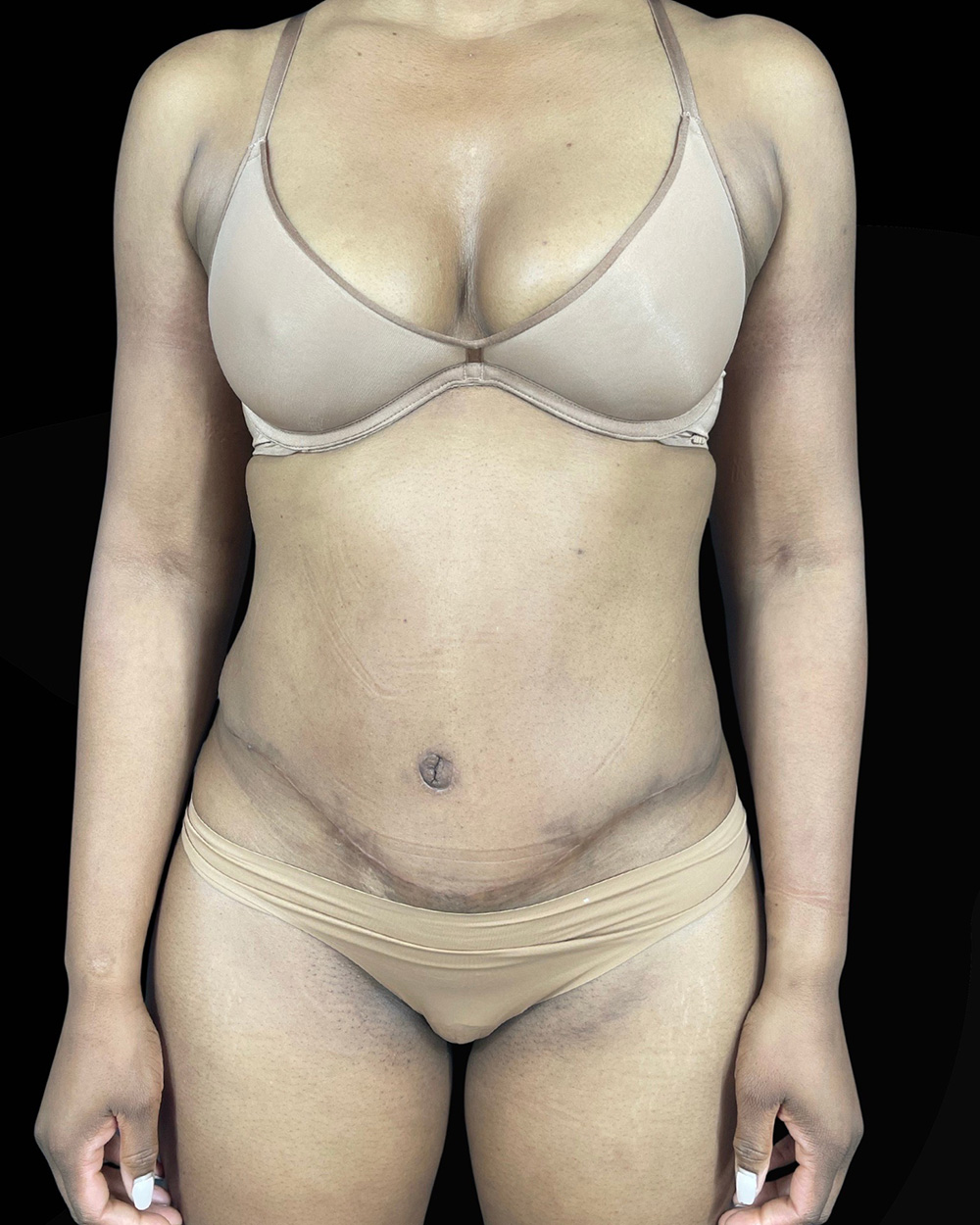 Case--1644 | After Abdominoplasty