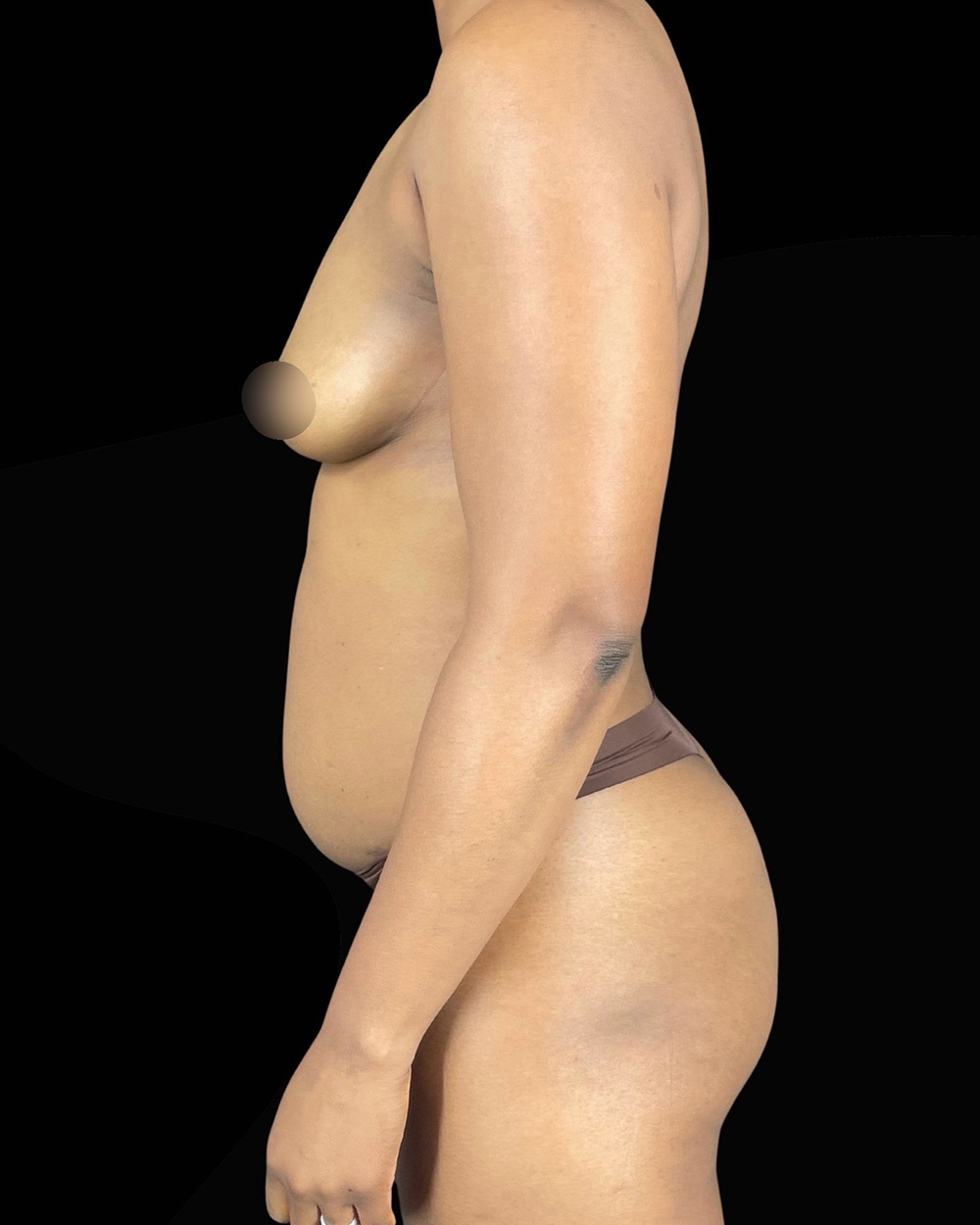 Case--1644 | Before Abdominoplasty 3