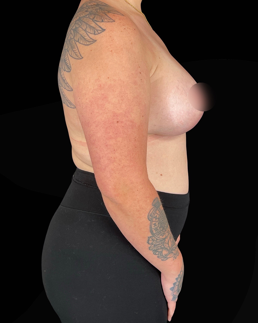 Case--4993 | After Breast Augmentation/Lift 3