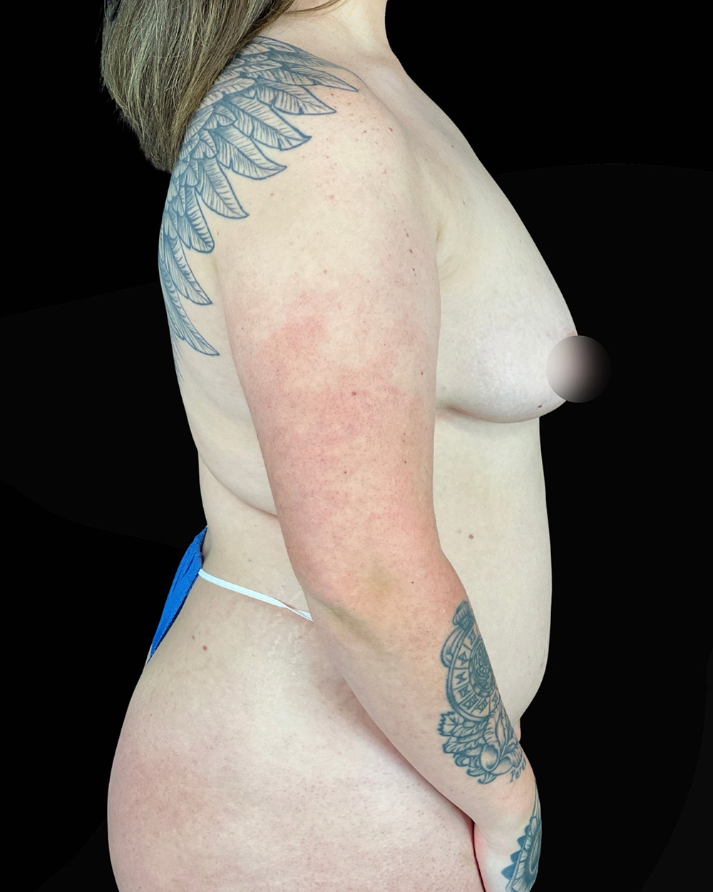 Case--4993 | Before Breast Augmentation/Lift 3