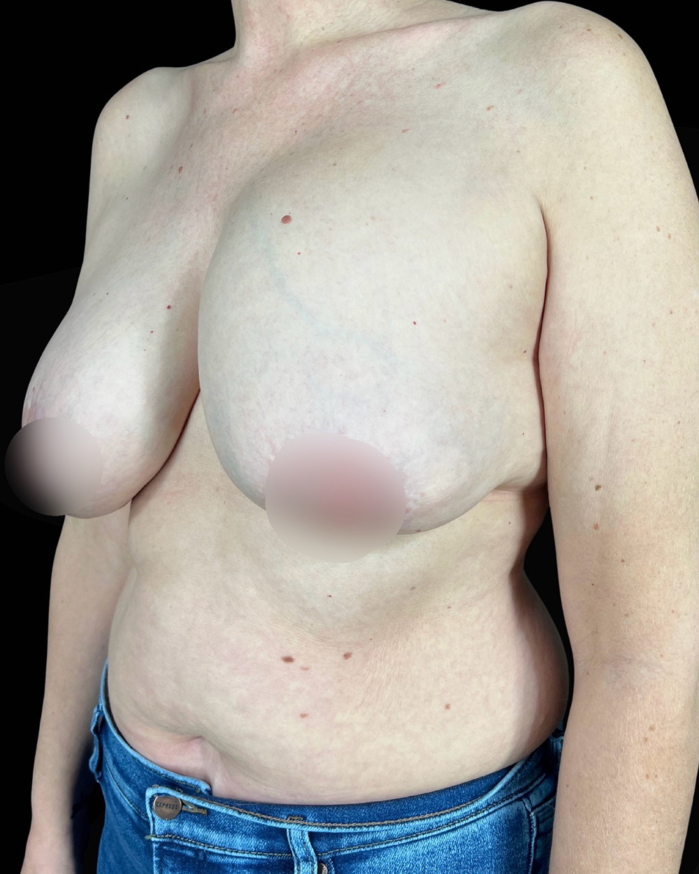 Case--6558 | Before Breast Augmentation/Lift