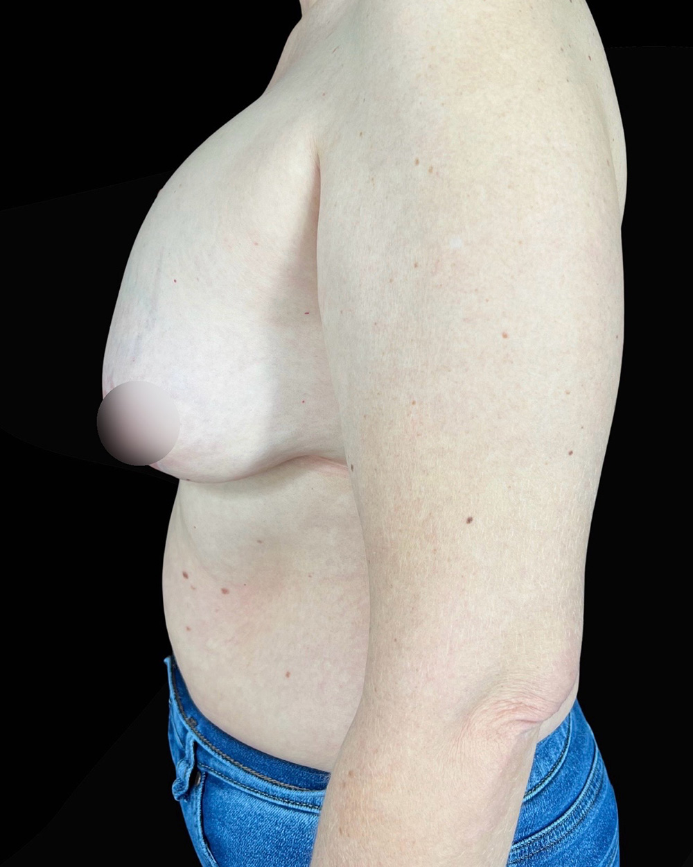 Case--6558 | Before Breast Augmentation/Lift 2