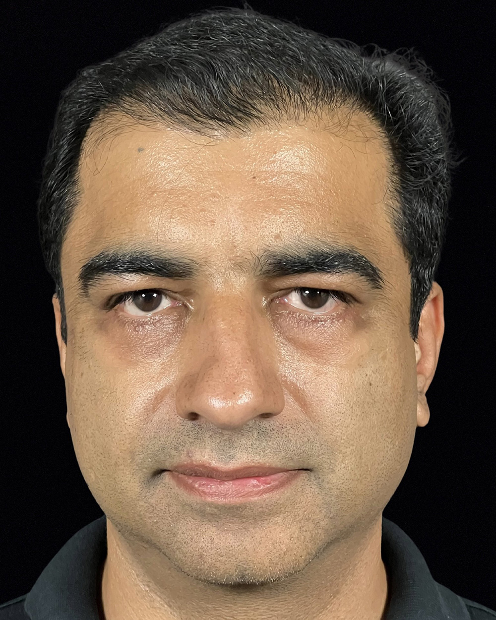 Case--3977 | After Blepharoplasty