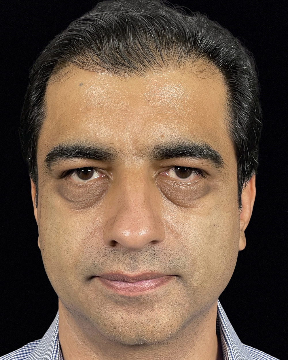 Case--3977 | Before Blepharoplasty