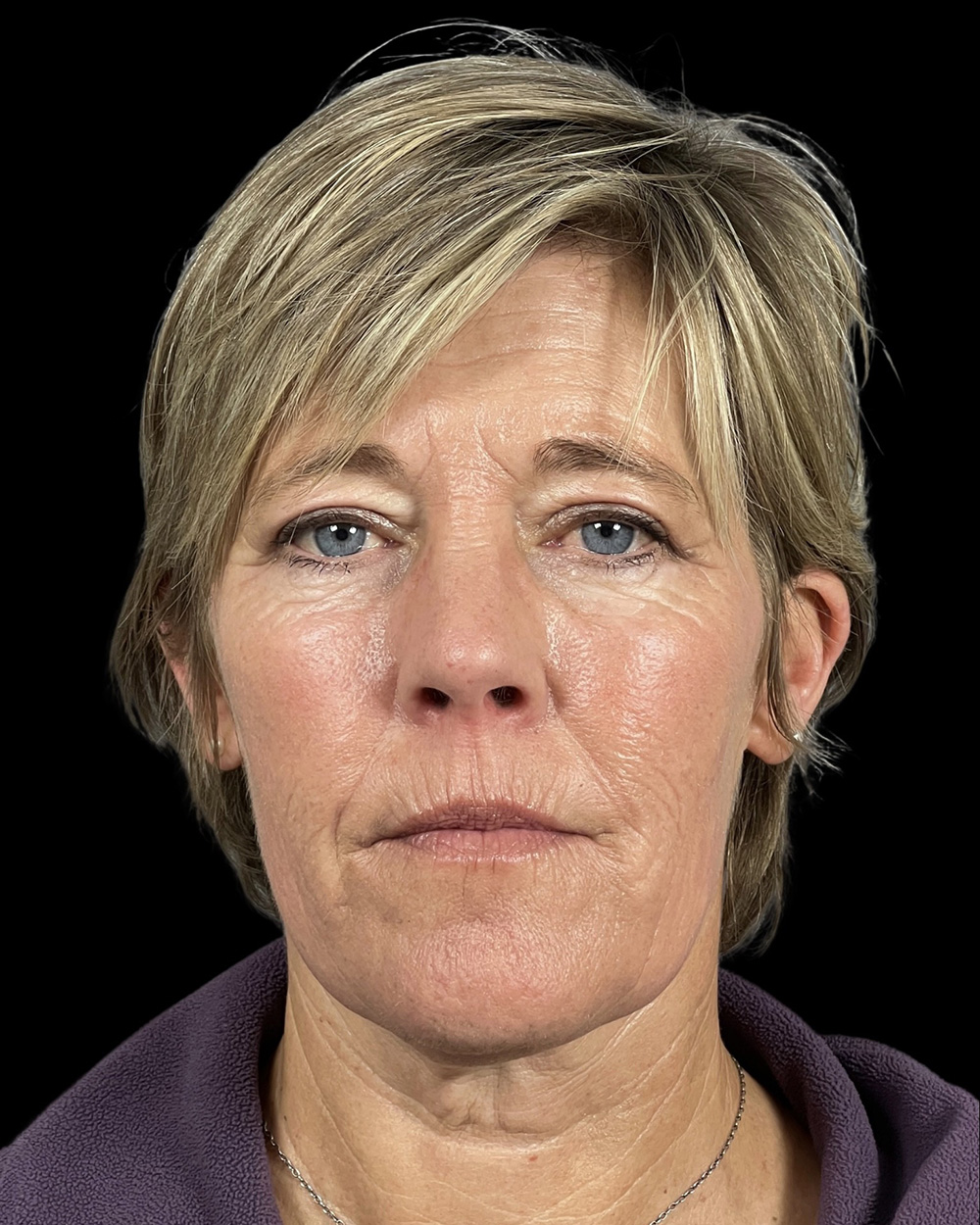 Case--8839 | After Blepharoplasty