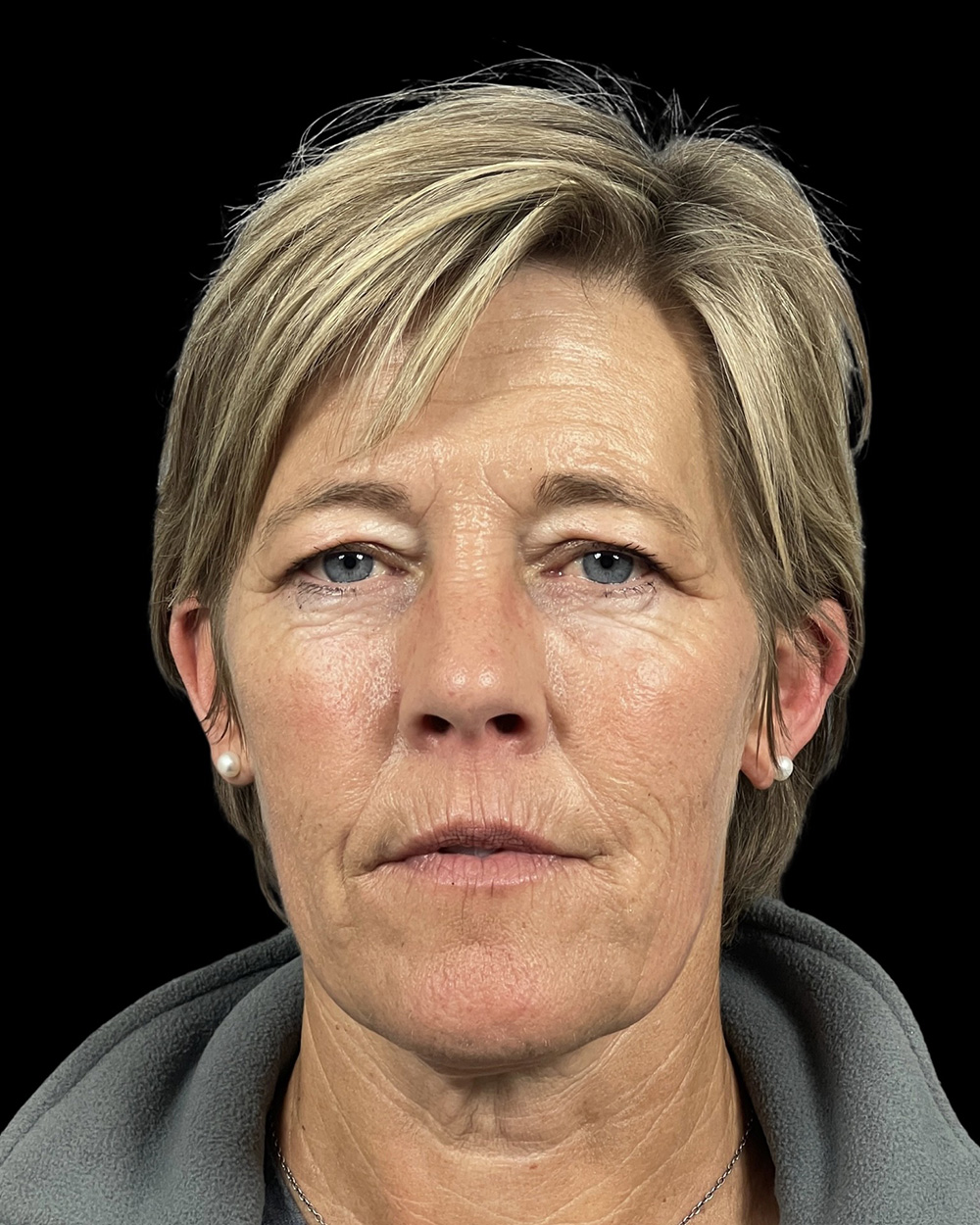 Case--8839 | Before Blepharoplasty