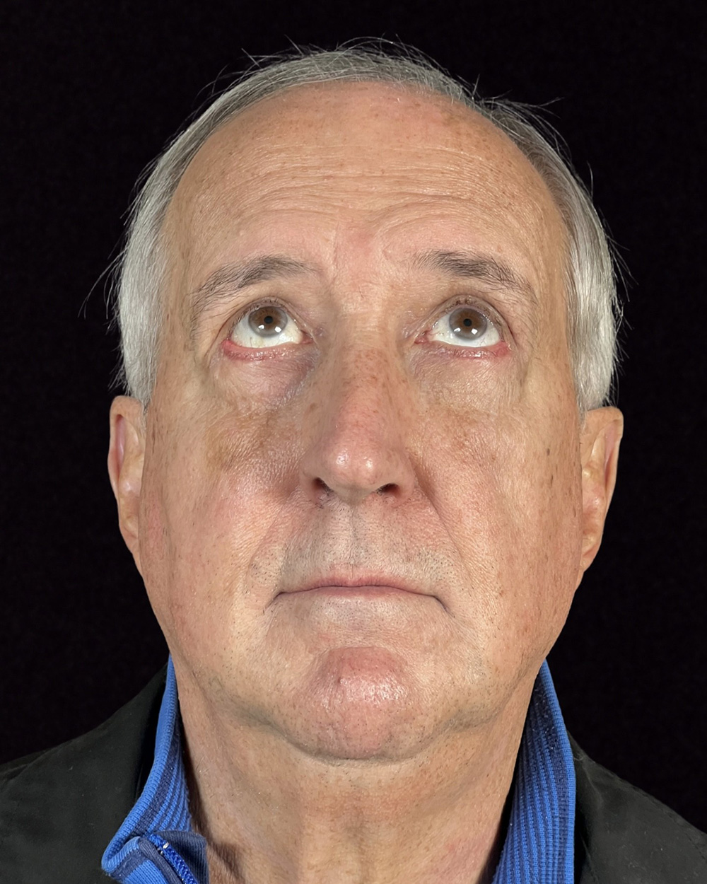 Case--5299 | After Blepharoplasty