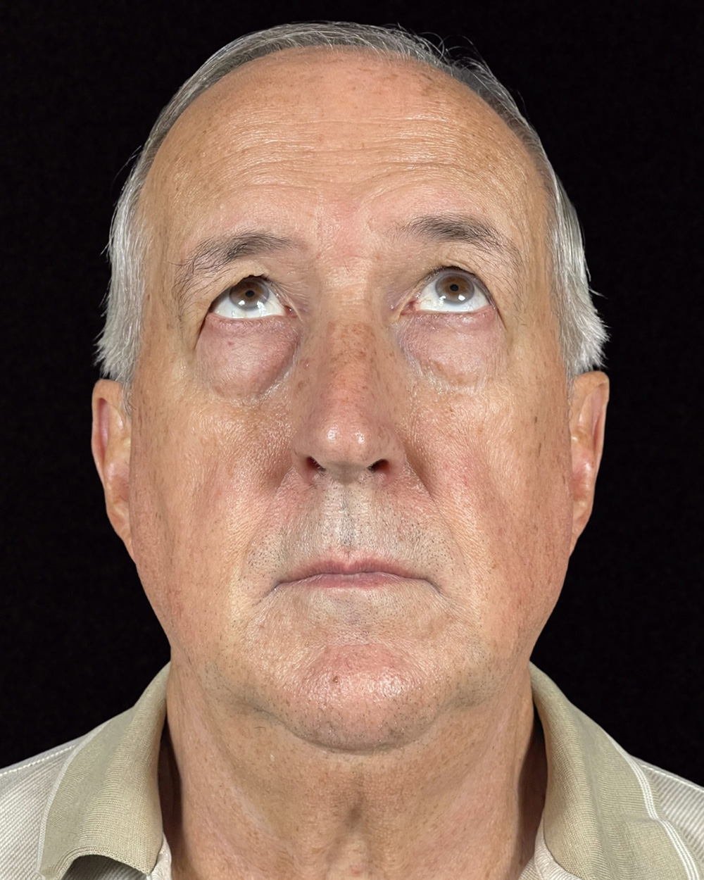 Case--5299 | Before Blepharoplasty