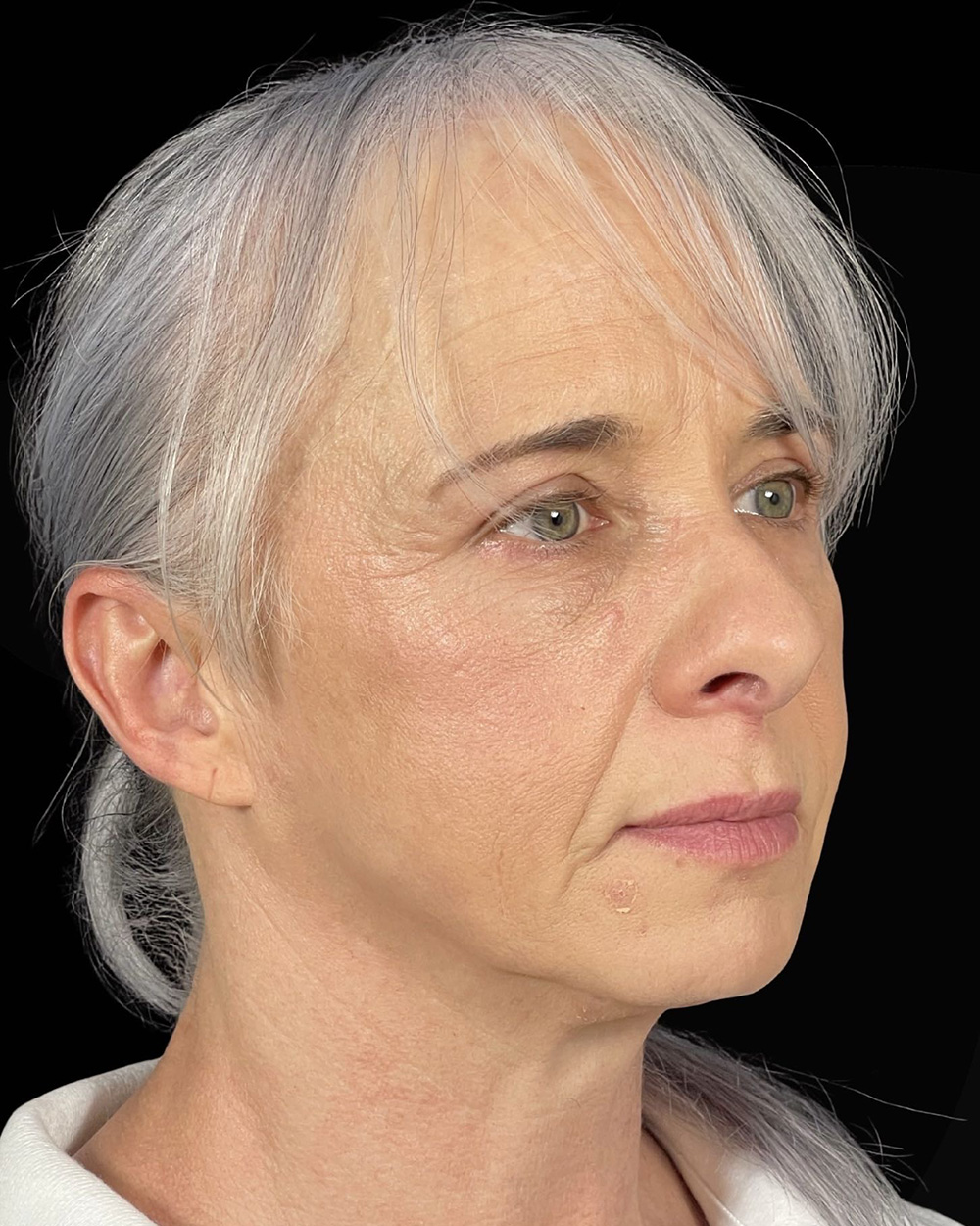 Case--7507 | After Blepharoplasty 3