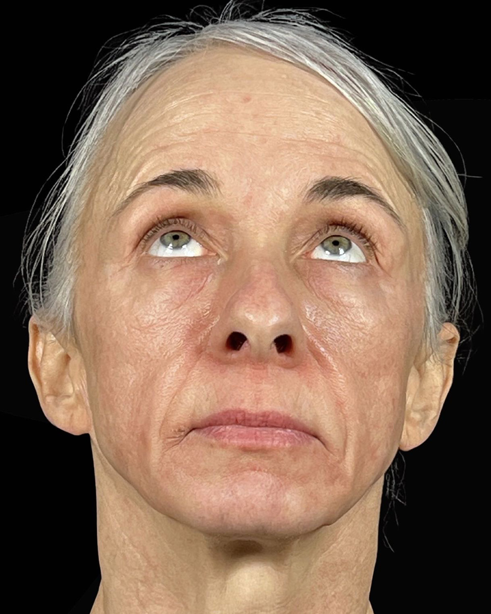 Case--7507 | Before Blepharoplasty 2