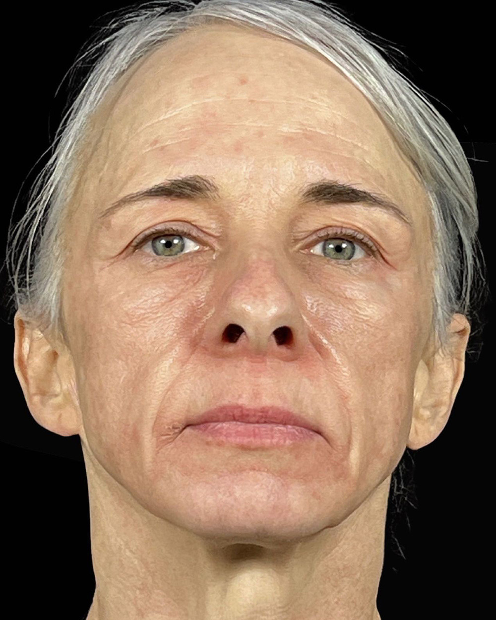 Case--7507 | Before Blepharoplasty