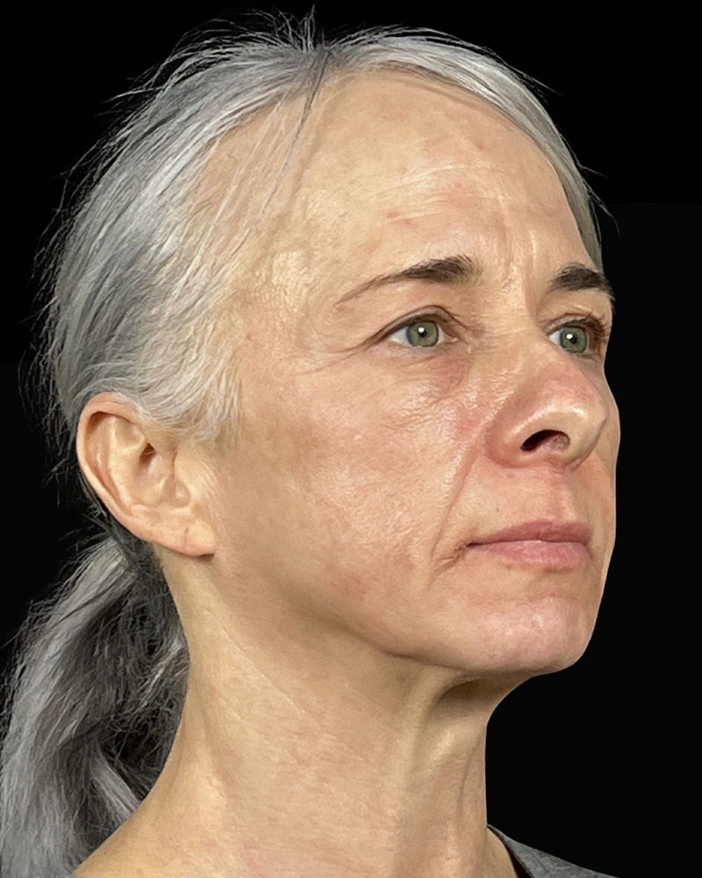 Case--7507 | Before Blepharoplasty 3