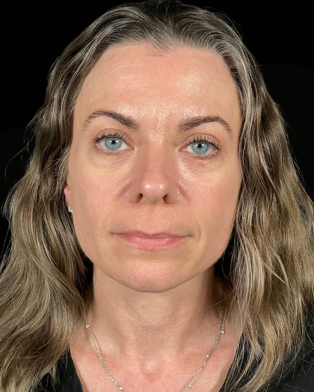 Case--9596 | After Blepharoplasty