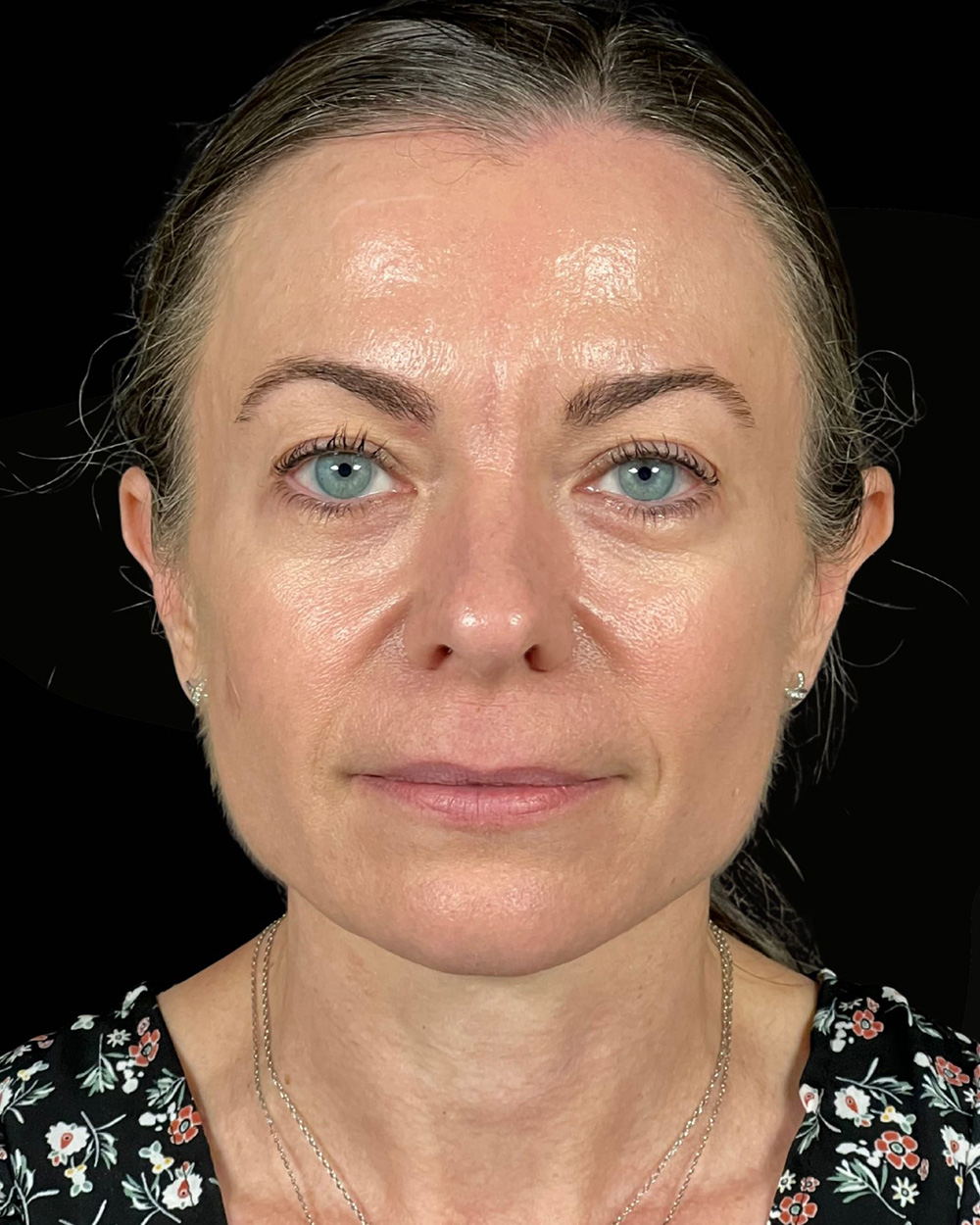 Case--9596 | Before Blepharoplasty
