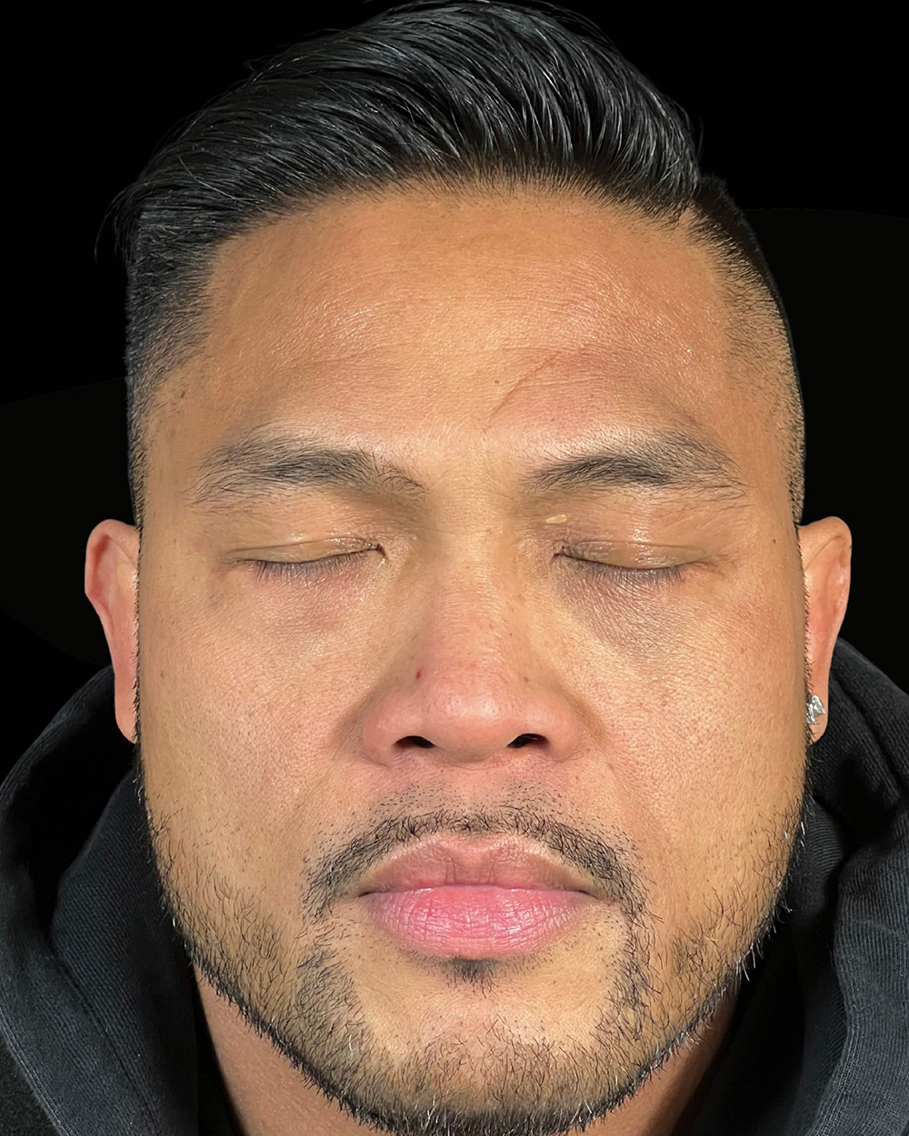 Case--4202 | After Blepharoplasty 2