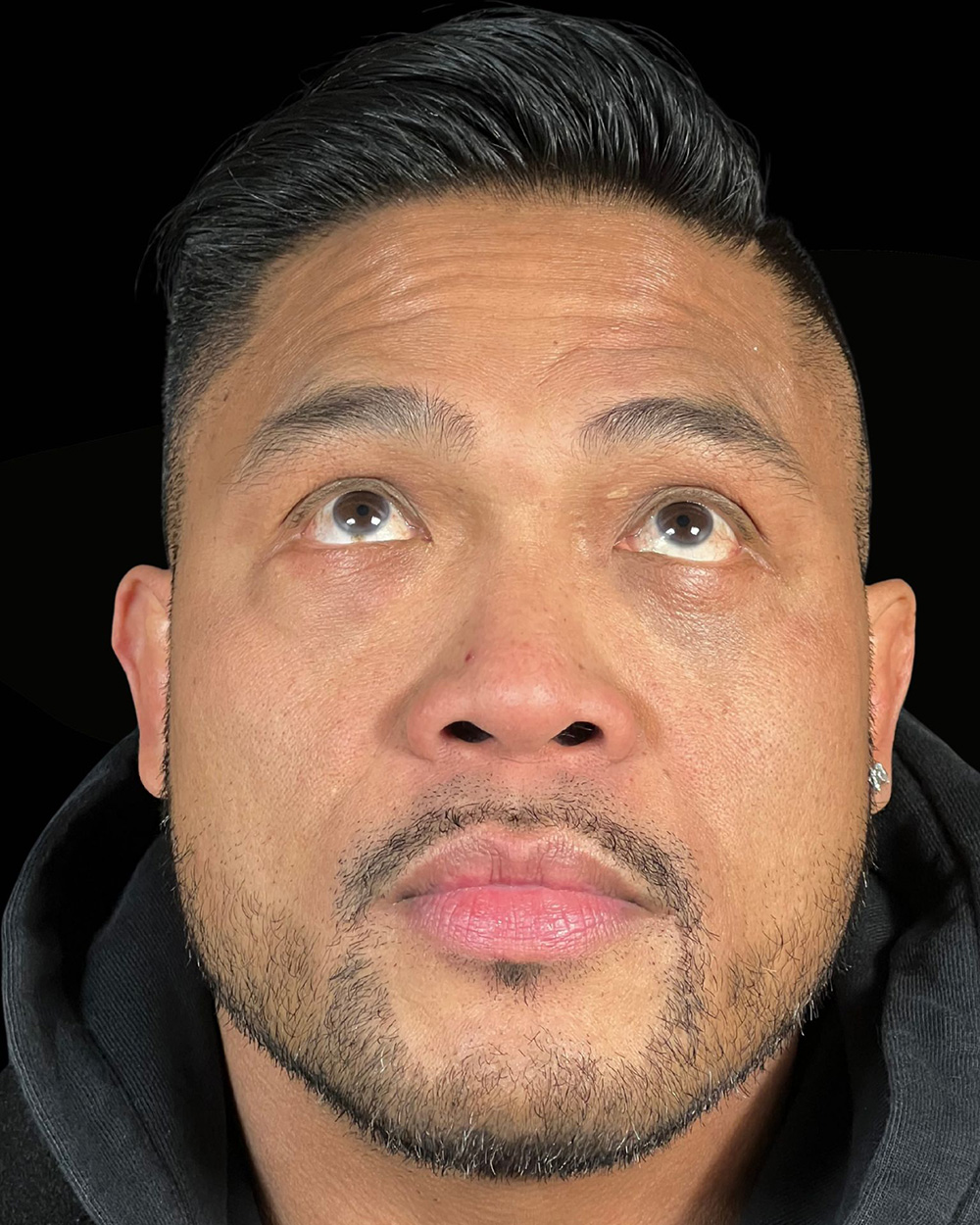 Case--4202 | After Blepharoplasty