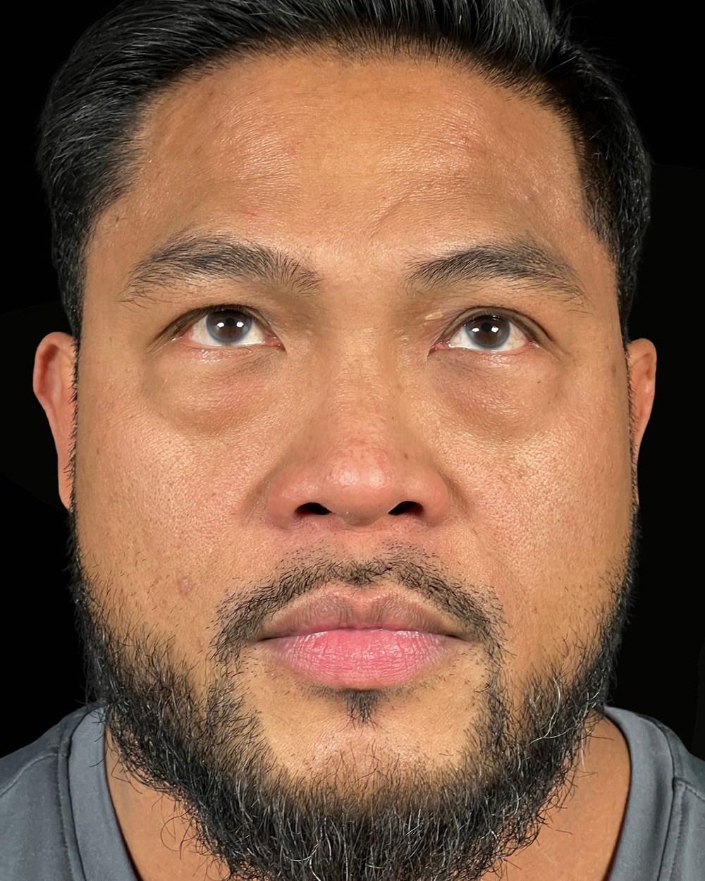 Case--4202 | Before Blepharoplasty