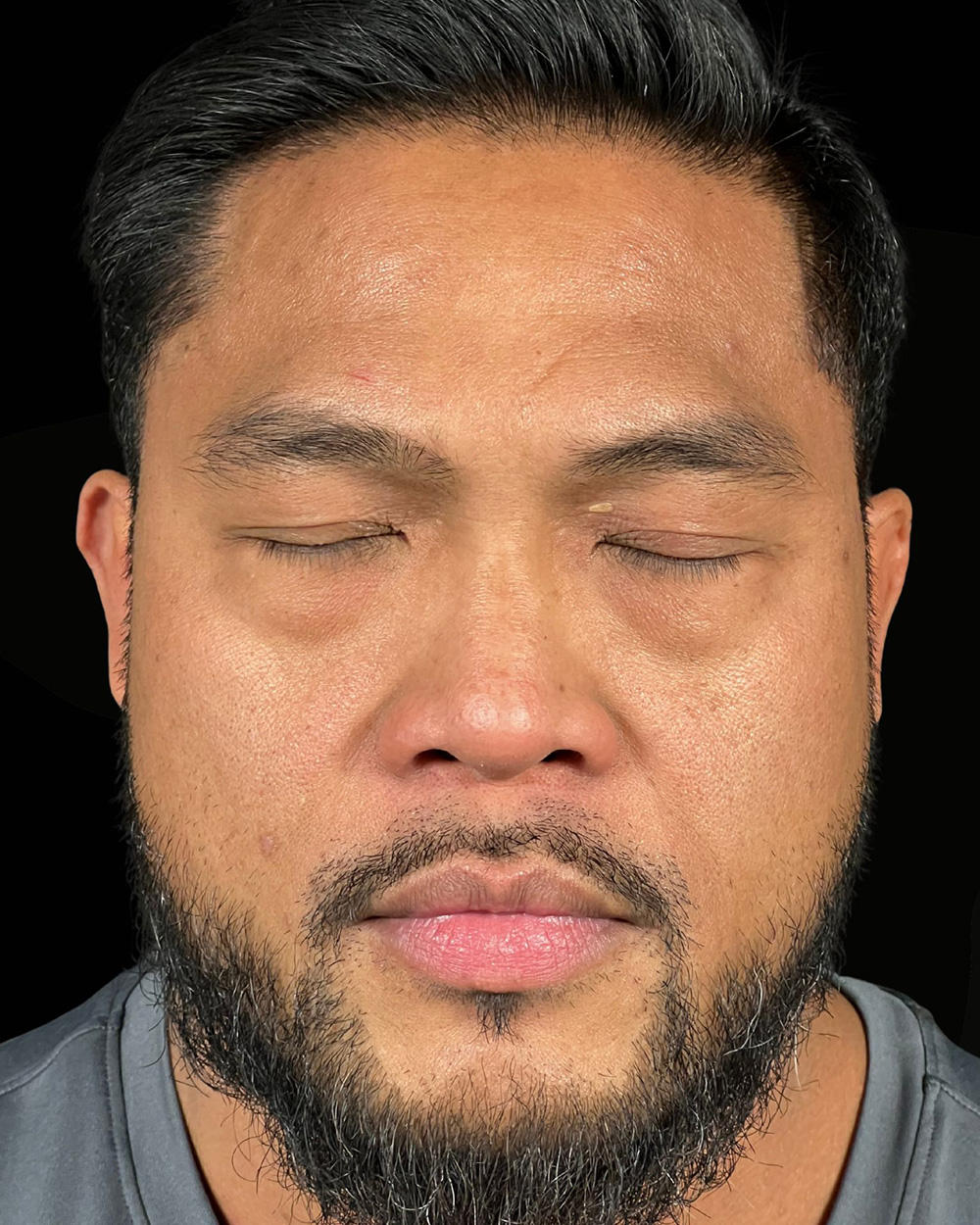 Case--4202 | Before Blepharoplasty 2