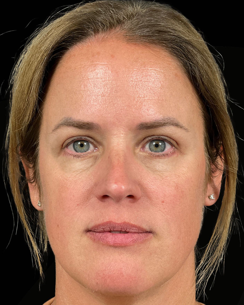 Case--6213 | After Blepharoplasty