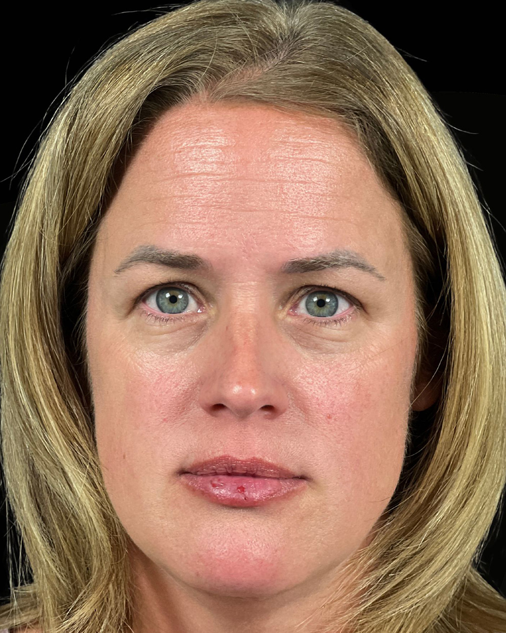 Case--6213 | Before Blepharoplasty