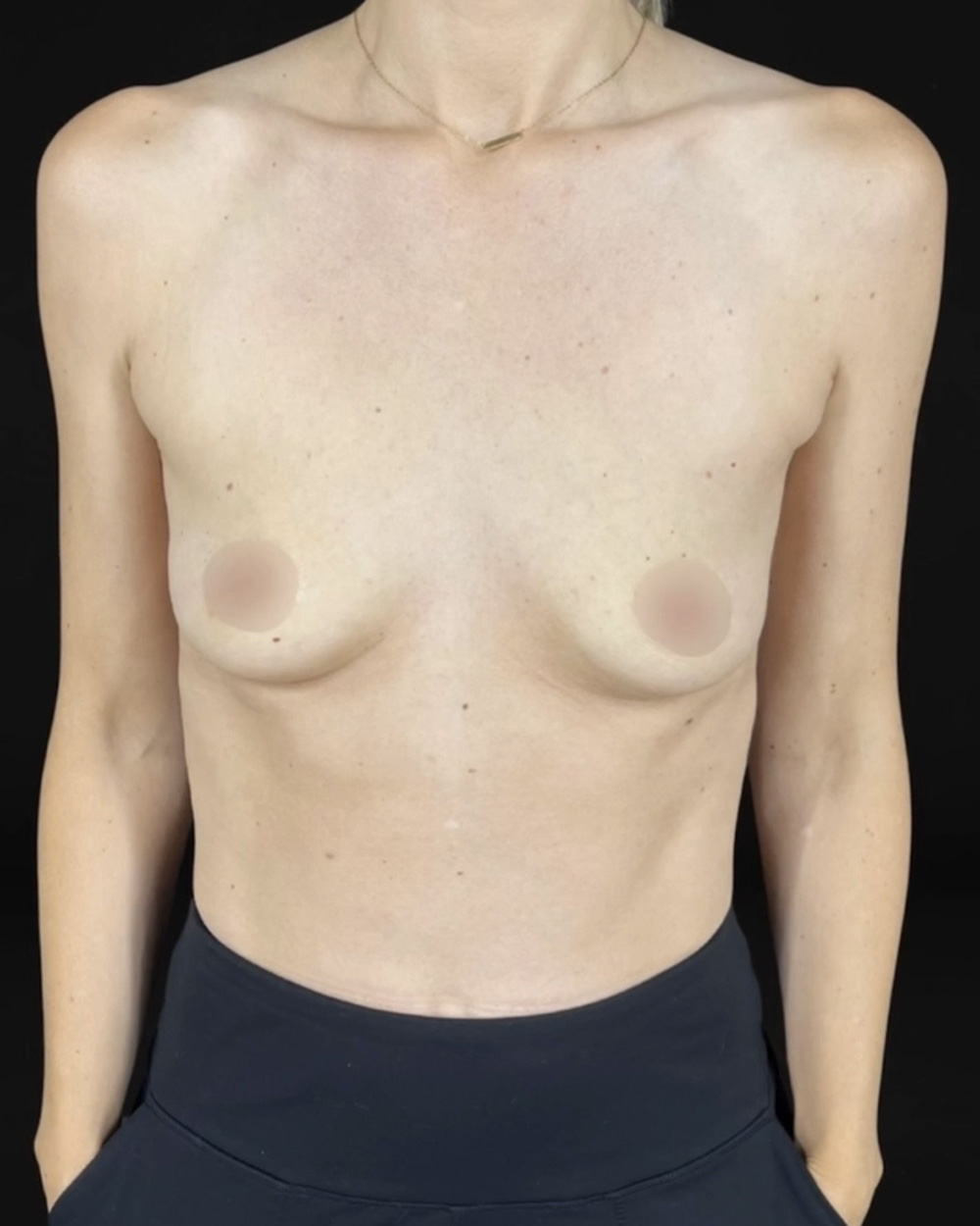 Case--9334 | Before Breast Augmentation