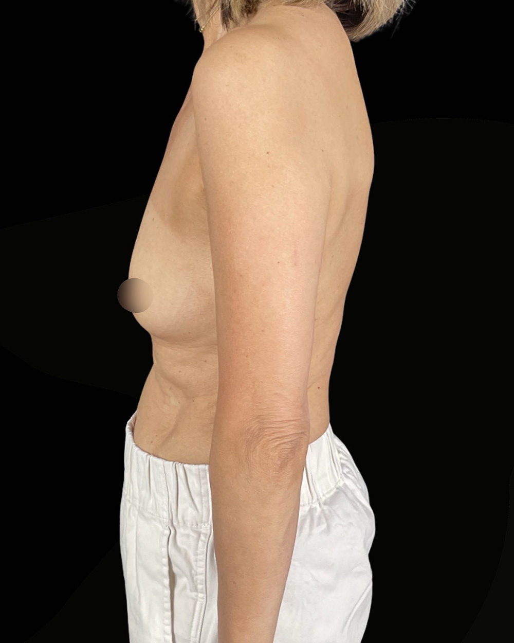 Case--2539 | Before Breast Augmentation 3