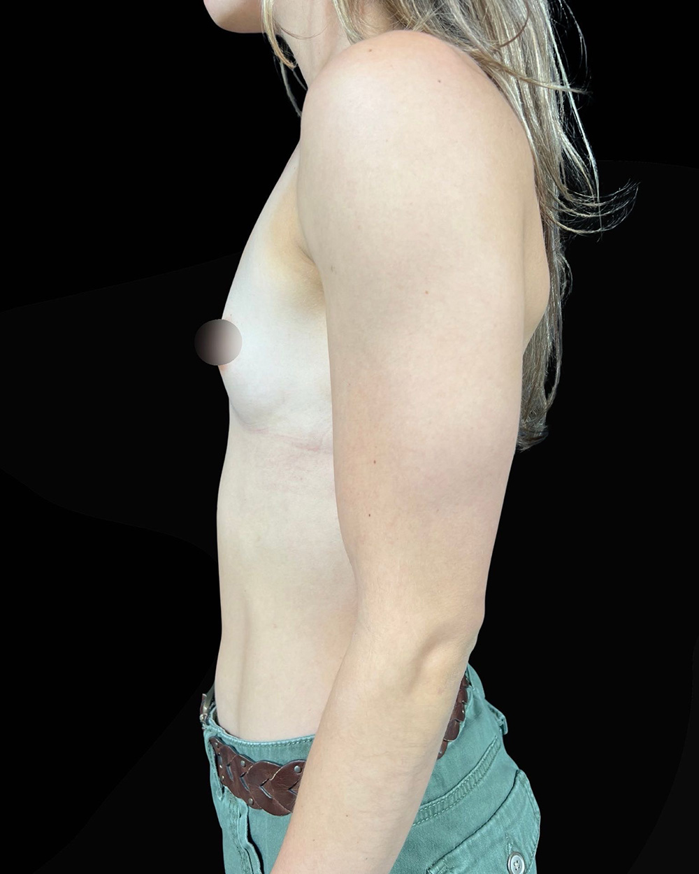 Case--1218 | Before Breast Augmentation 3