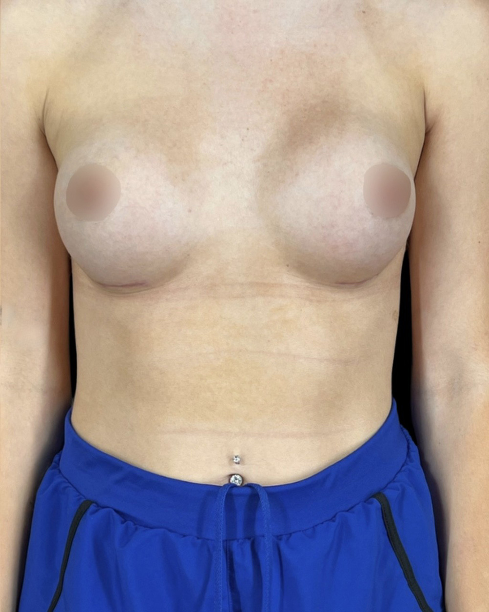 Case--1627 | After Breast Augmentation