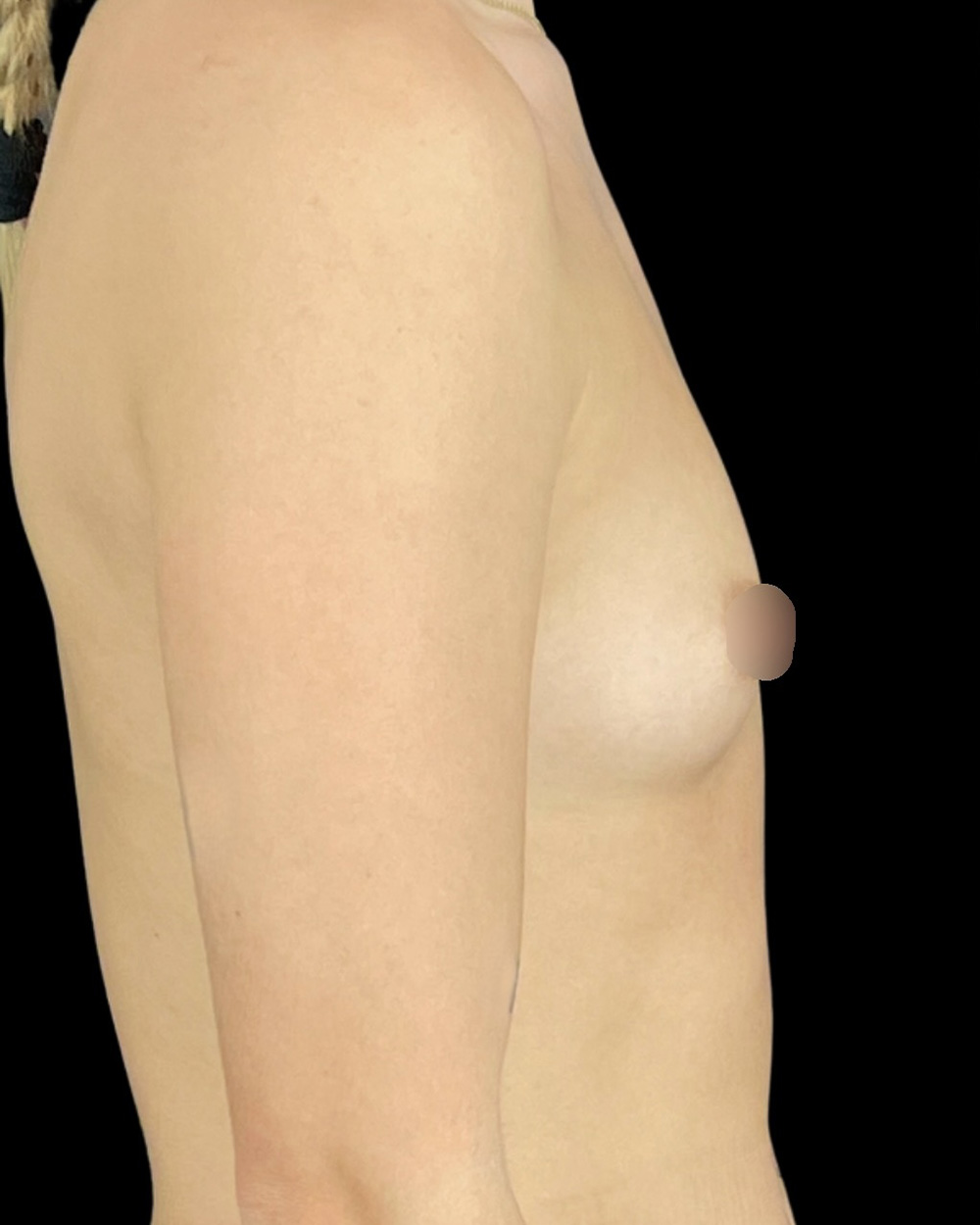 Case--1627 | Before Breast Augmentation 3