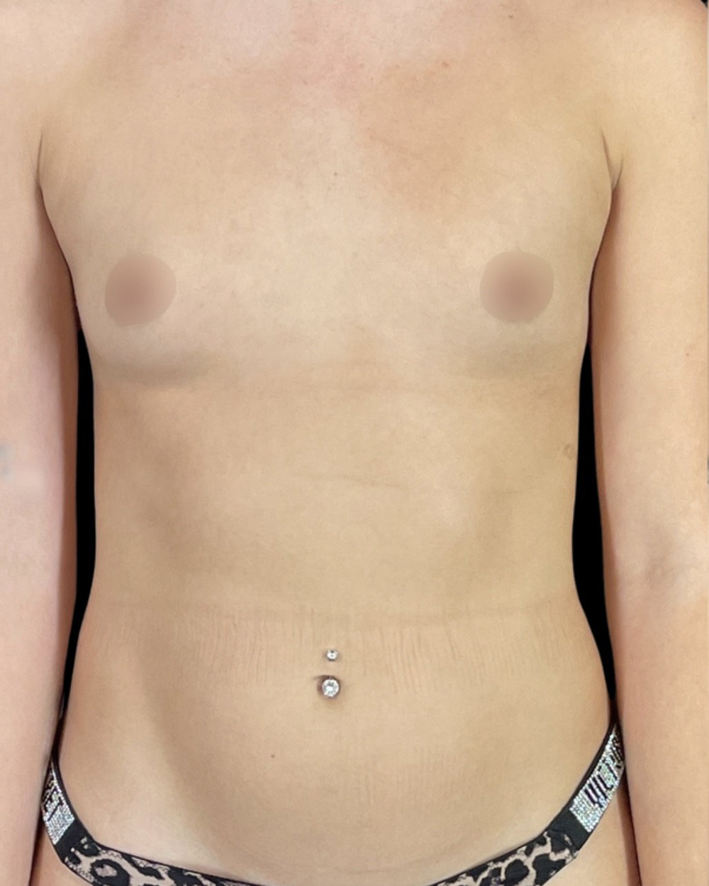 Case--1627 | Before Breast Augmentation