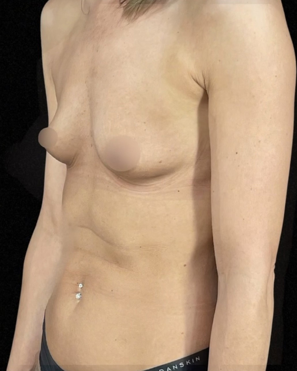 Case--1548 | Before Breast Augmentation 2
