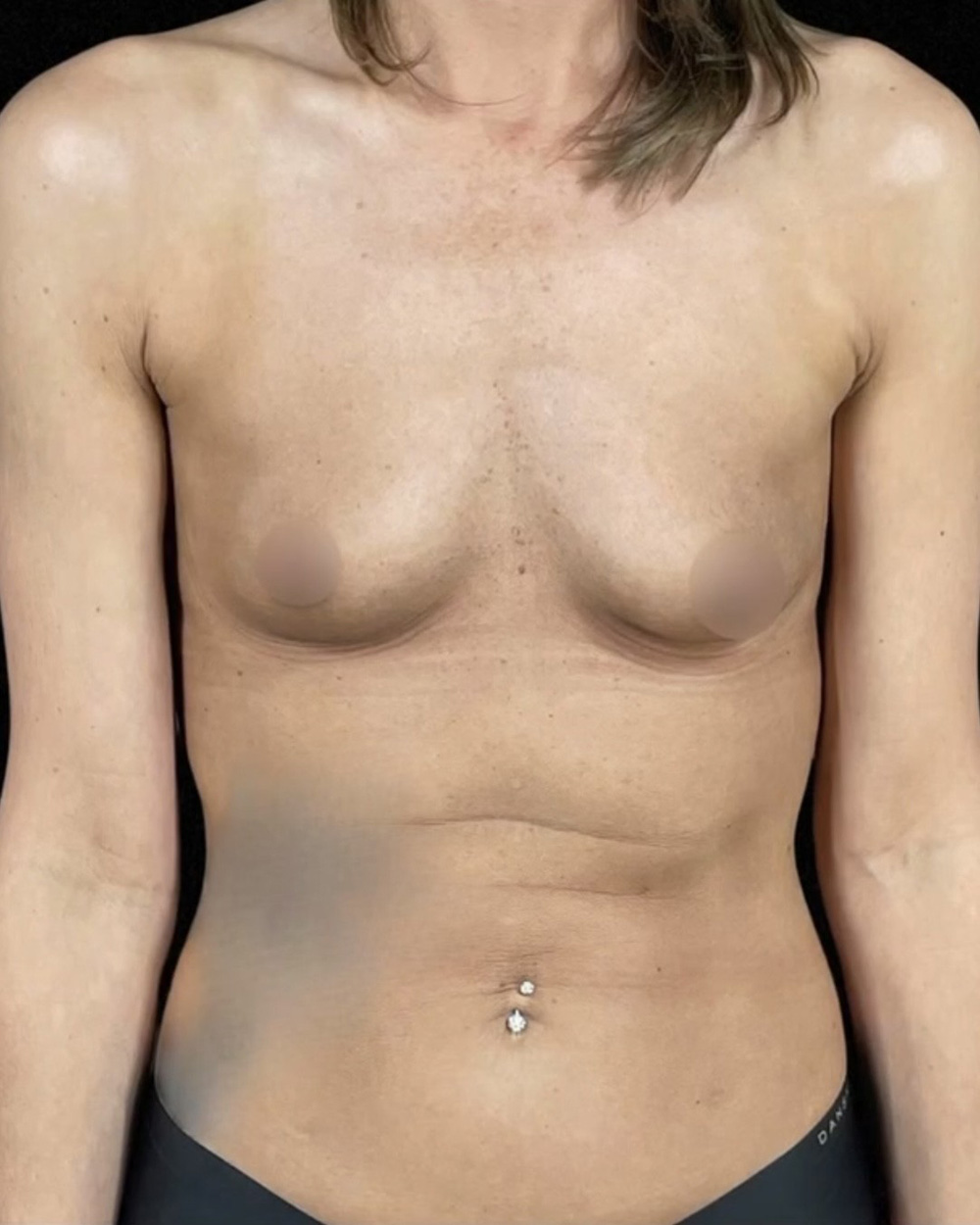 Case--1548 | Before Breast Augmentation