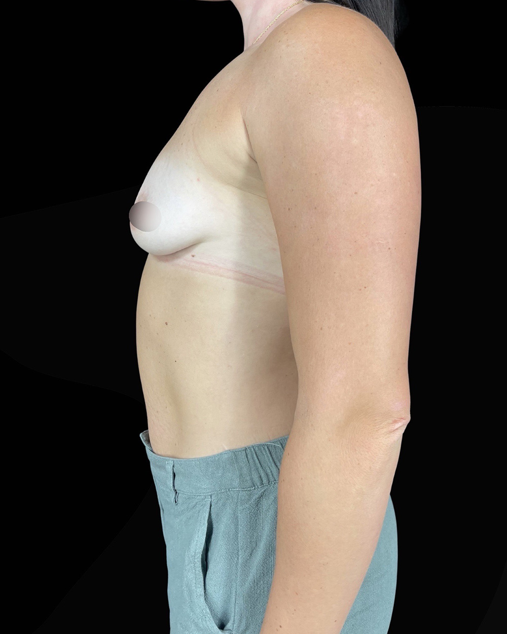 Case--5393 | Before Breast Augmentation 2