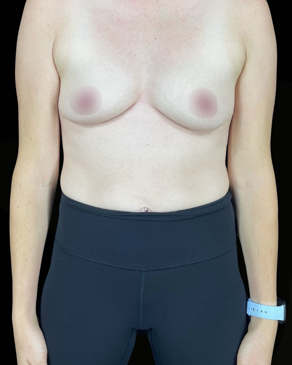 Case--4681 | Before Breast Augmentation