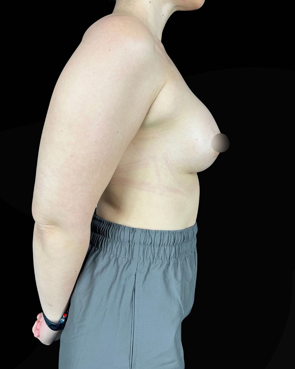 Case--1991 | After Breast Augmentation 3