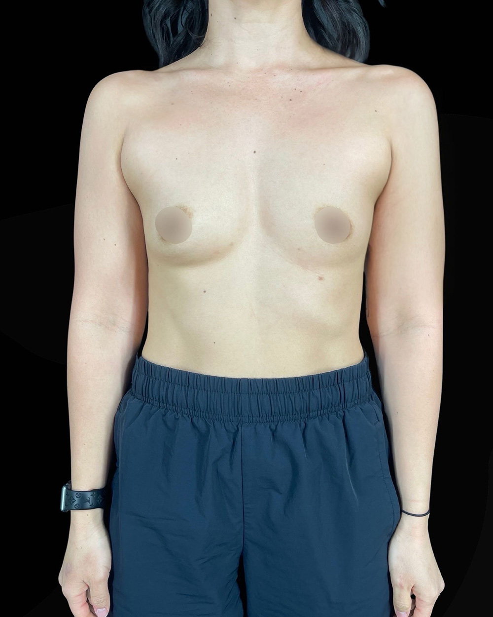 Case--1991 | Before Breast Augmentation