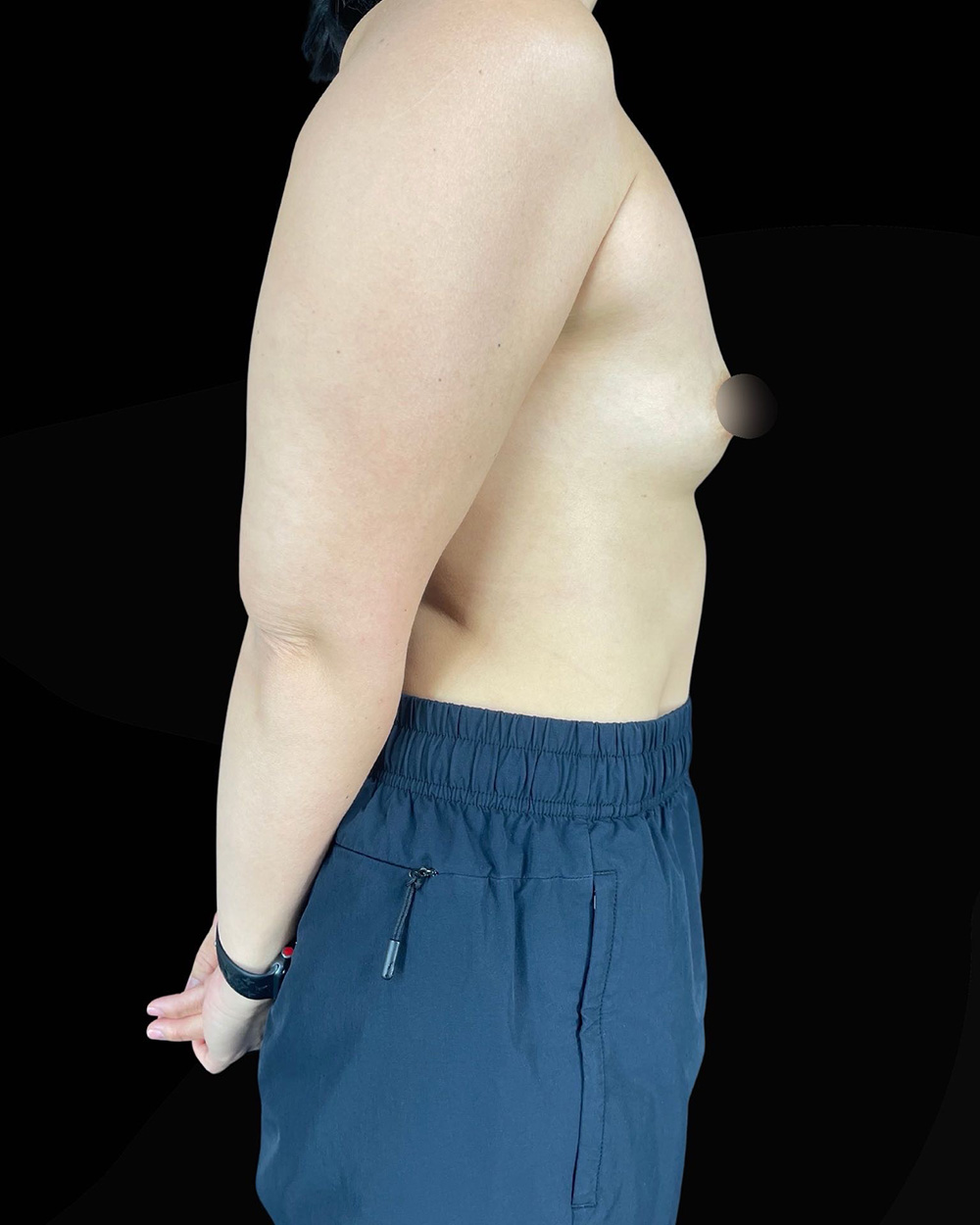 Case--1991 | Before Breast Augmentation 3