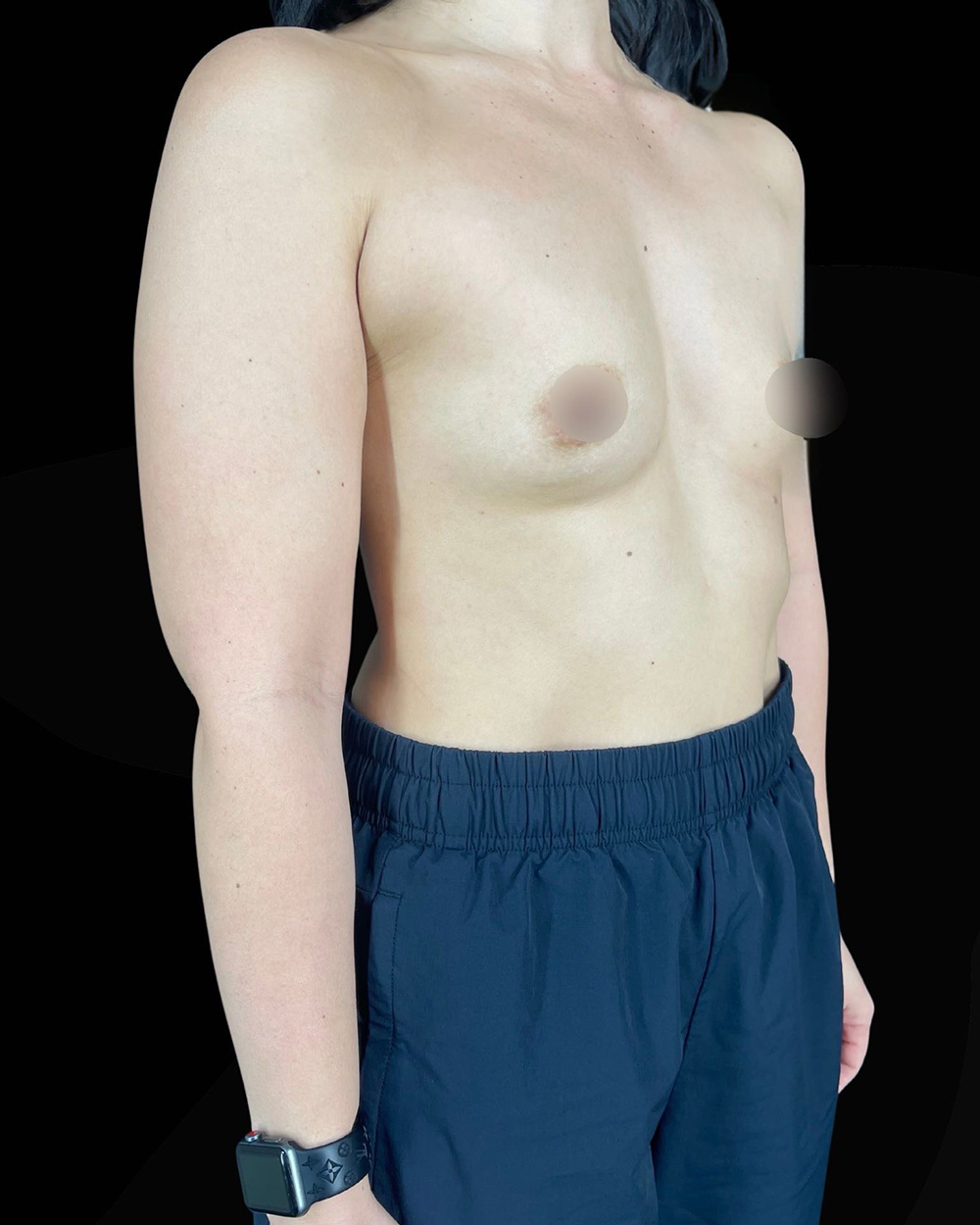 Case--1991 | Before Breast Augmentation 2