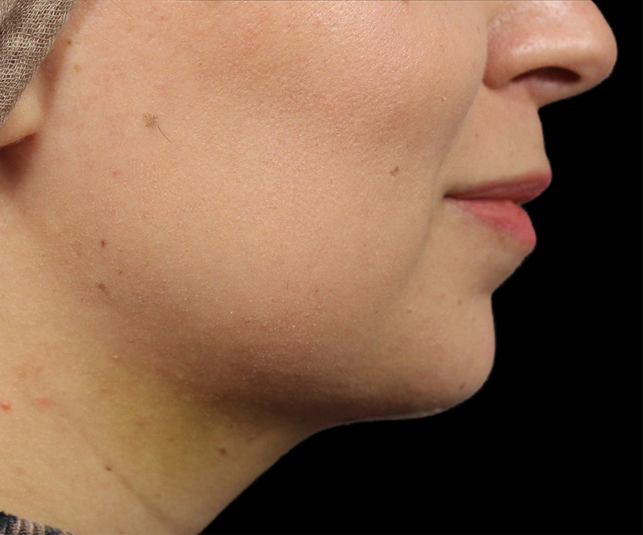 Case--7022 | After Liposuction - Chin