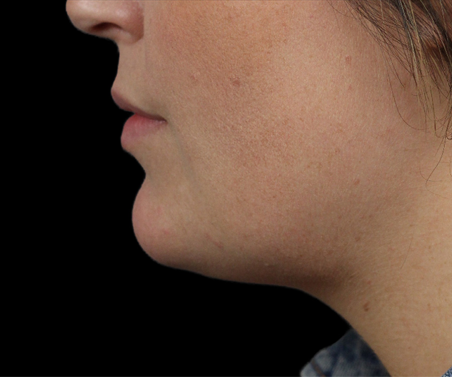 Case--5898 | After Liposuction - Chin