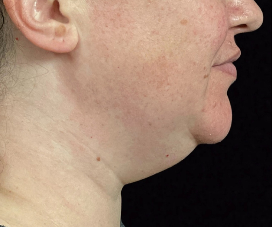 Case--5458 | Before Liposuction - Chin