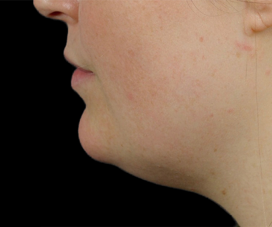 Case--5898 | Before Liposuction - Chin