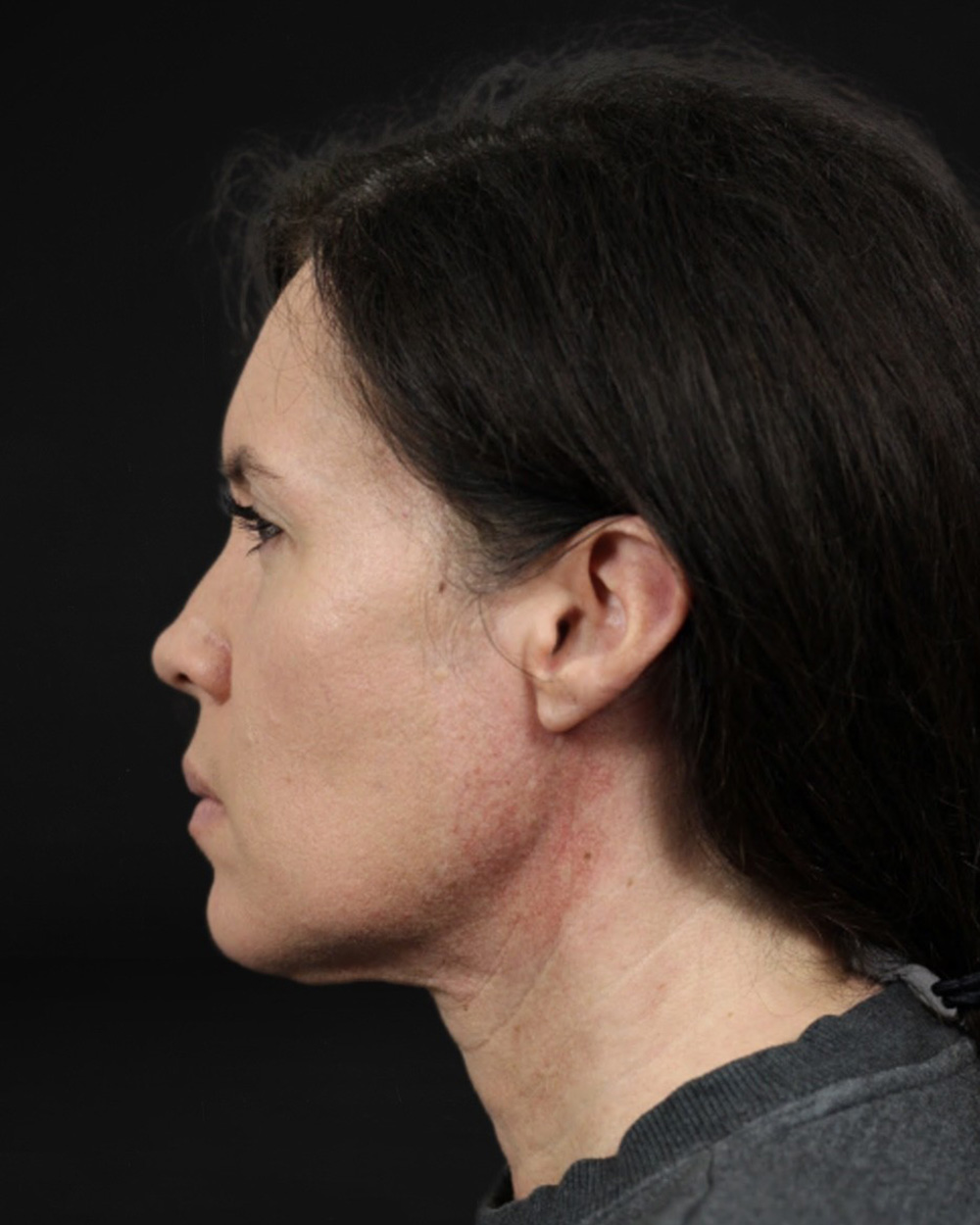 Case--7672 | After Facelift/Neck Lift 2