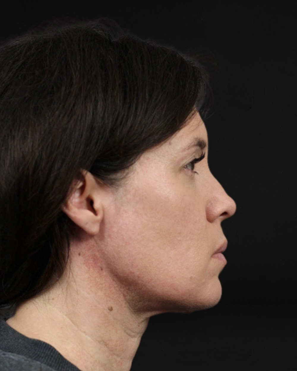 Case--7672 | After Facelift/Neck Lift