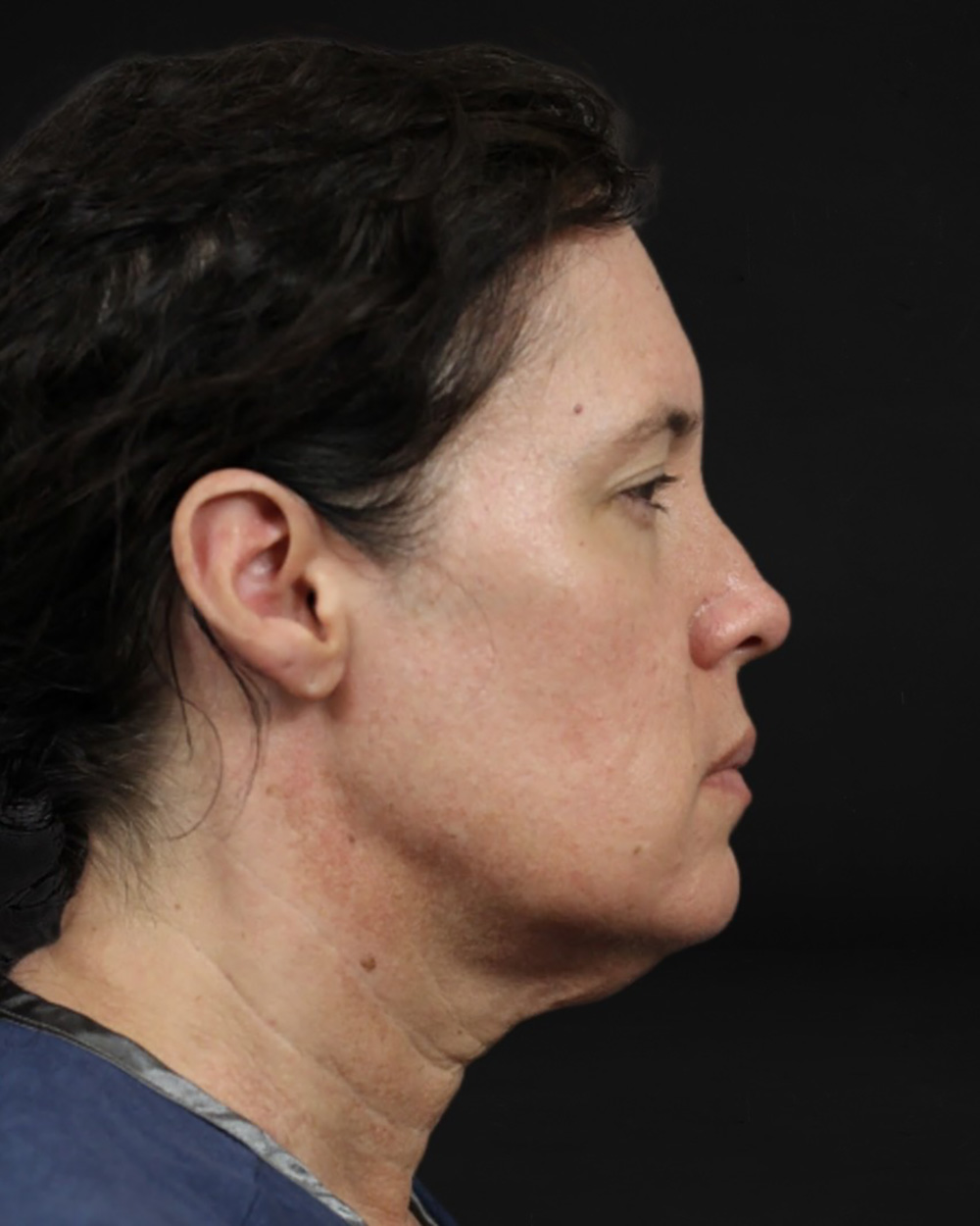 Case--7672 | Before Facelift/Neck Lift