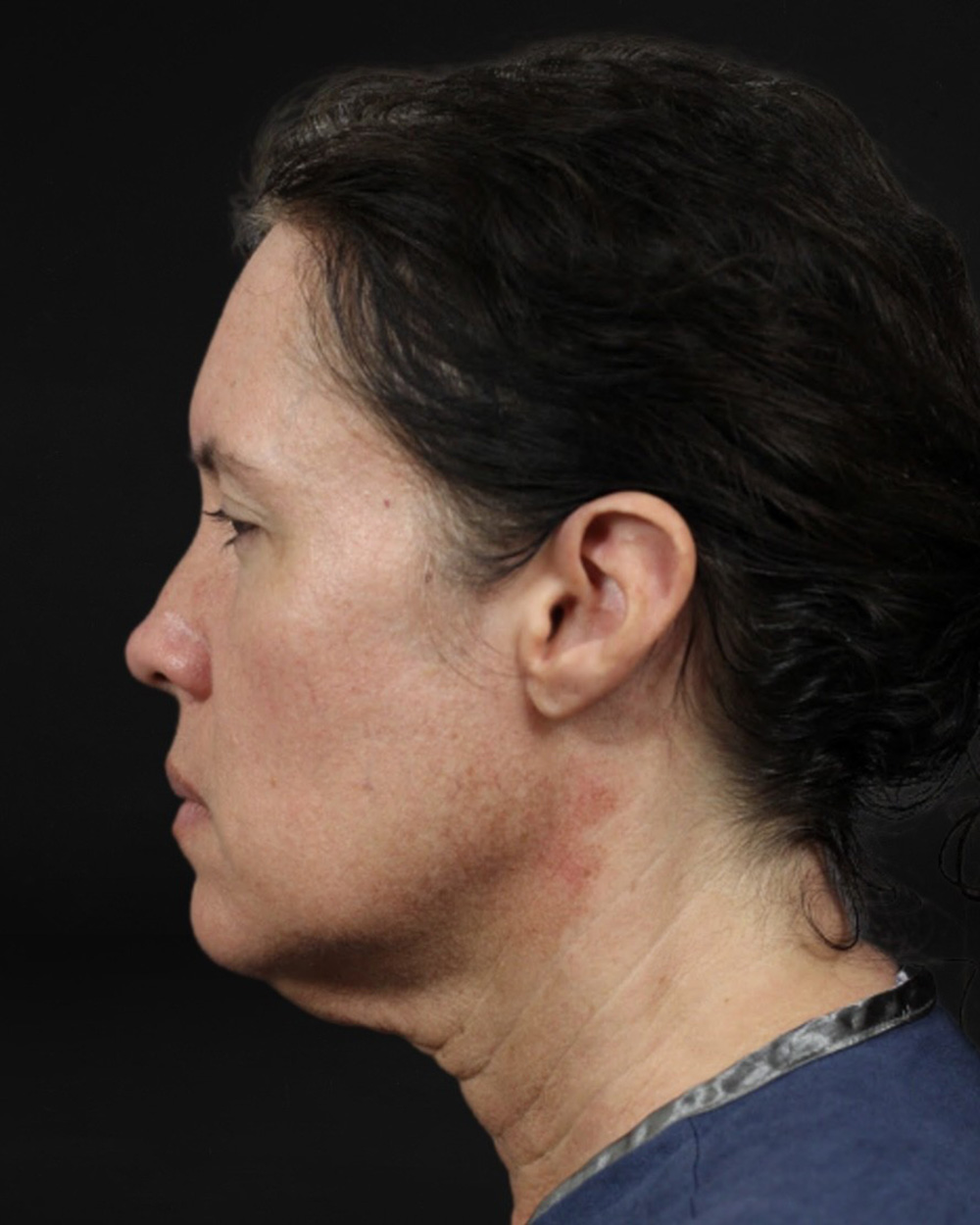 Case--7672 | Before Facelift/Neck Lift 2