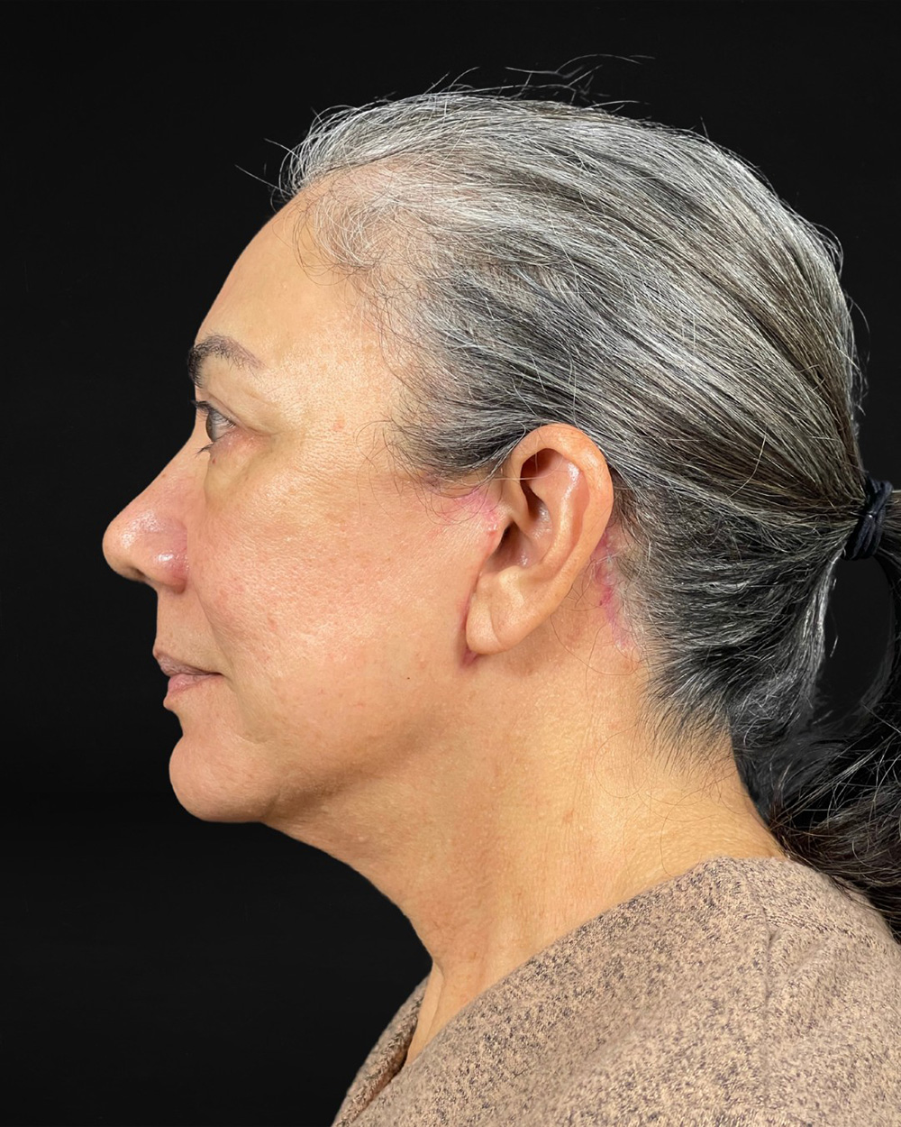 Case--4231 | After Facelift/Neck Lift