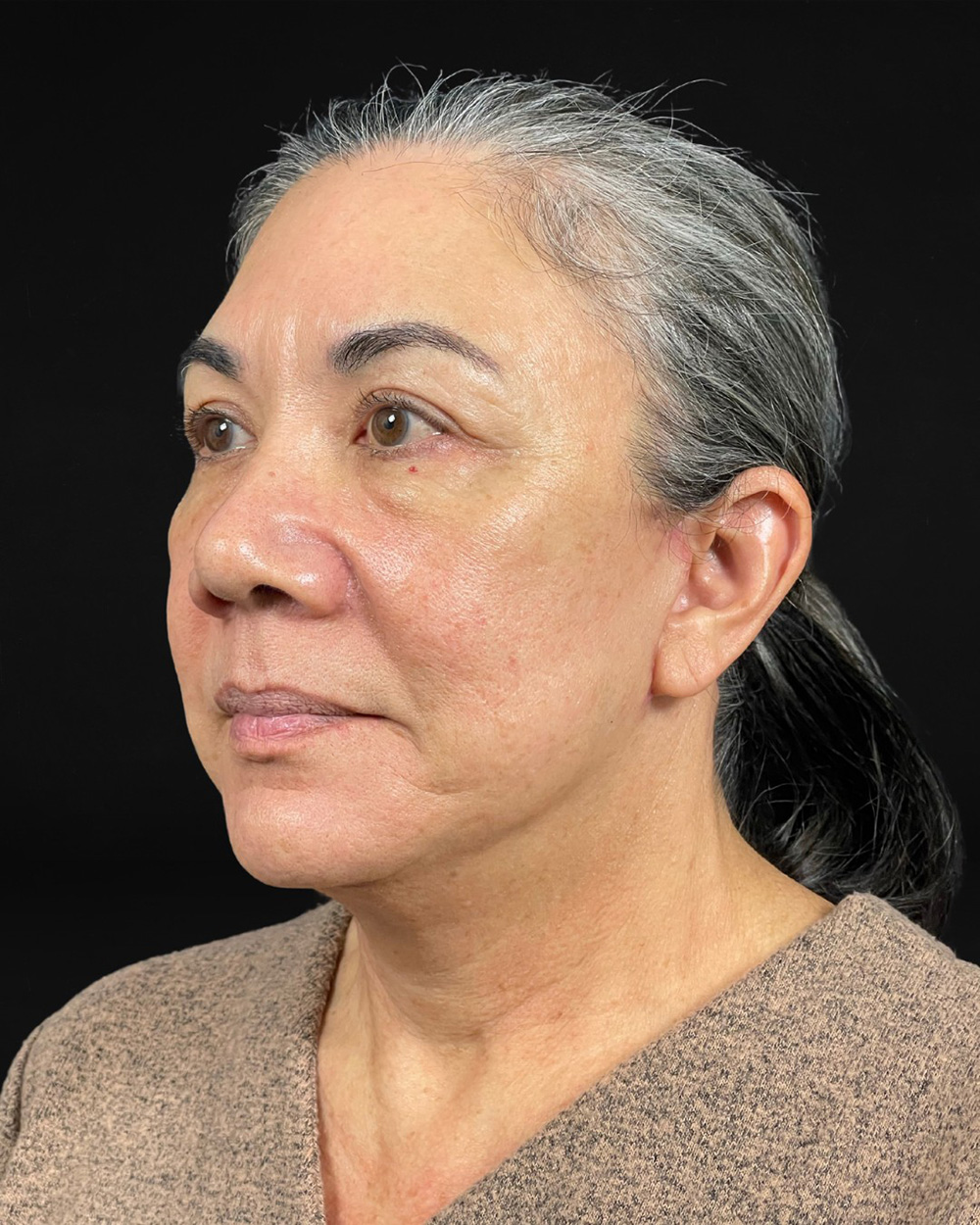 Case--4231 | After Facelift/Neck Lift 2