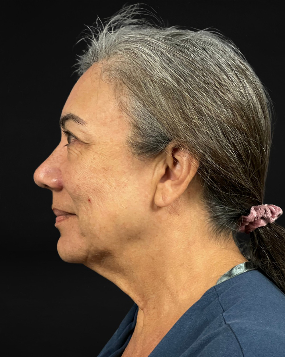 Case--4231 | Before Facelift/Neck Lift