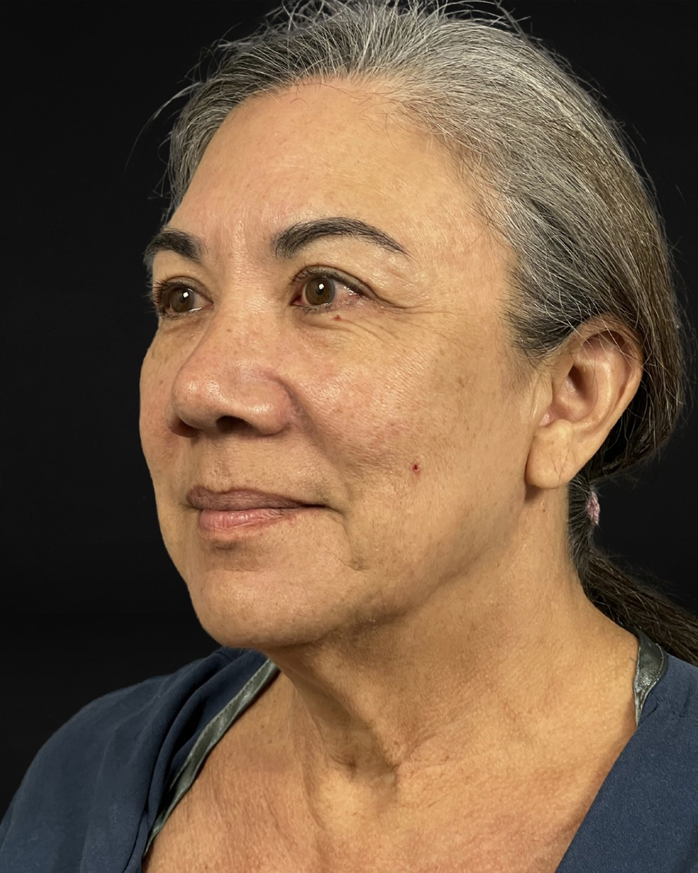 Case--4231 | Before Facelift/Neck Lift 2